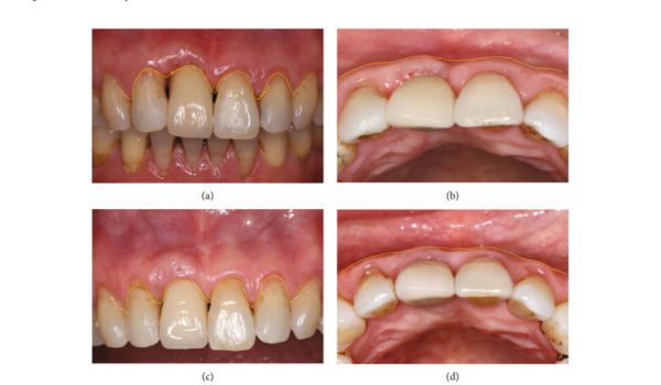 Palatal Pedicle Connective Tissue for Reconstruction