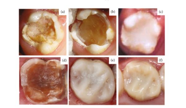 Selective Caries Removal: A Case Report with 21-Year Follow-Up