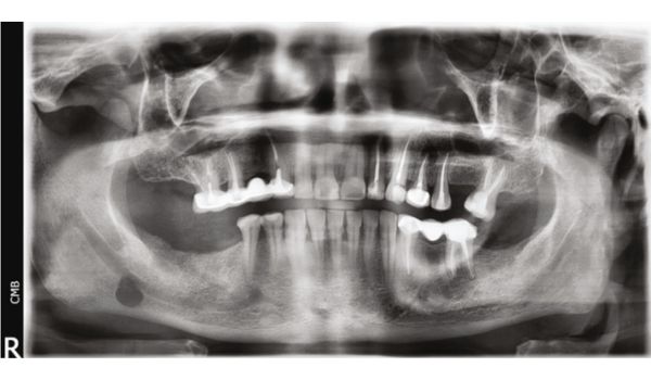 Stafne’s Bone Defect Correlated with Submandibular Glands