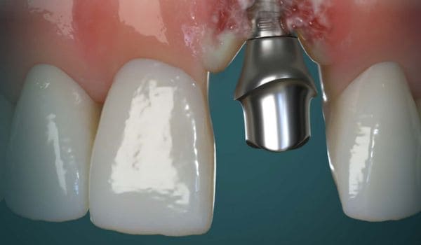 The All-In Implant Concept