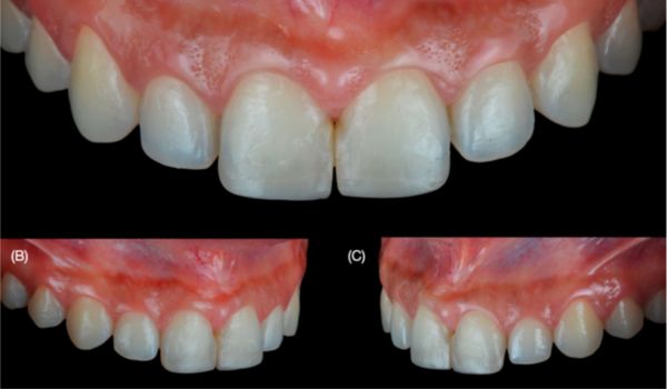 Three Dimensional-Printed Gingivectomy and Tooth Reduction
