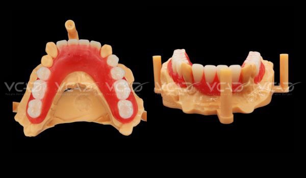 Lower partial denture of Marta Gomez Contreras