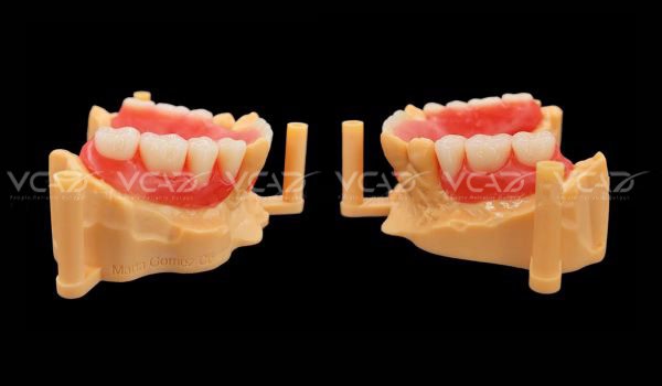 Lower partial denture of Marta Gomez Contreras