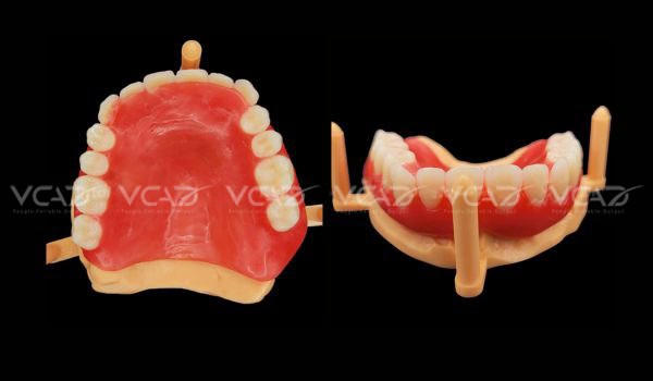 Upper Denture