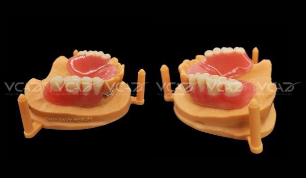 Upper Partial Denture - Chandavy Roeum