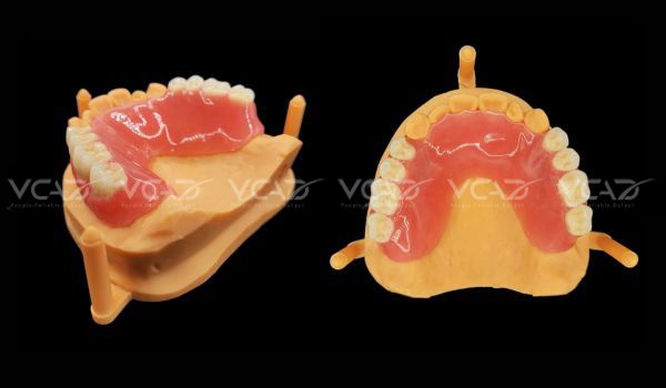 Front view: Upper Partial Denture - Chandavy Roeum