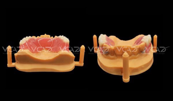 Upper Partial Denture - Chandavy Roeum