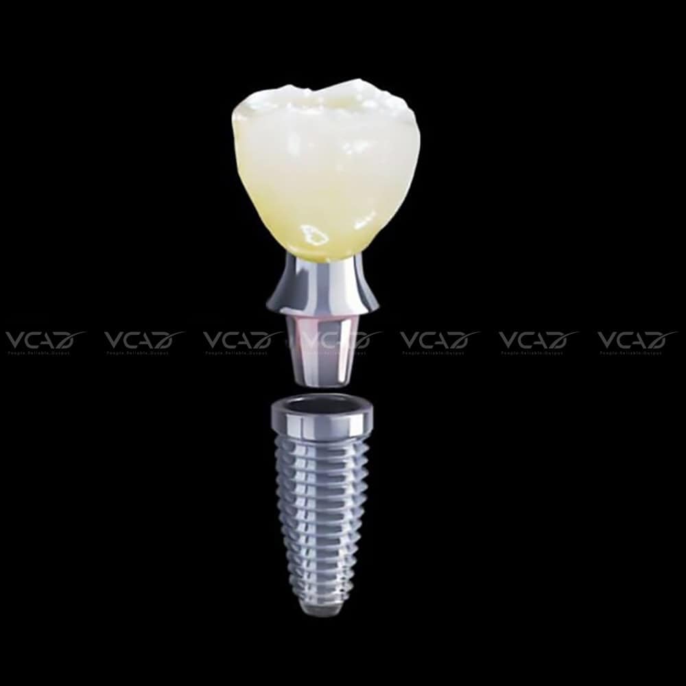 layered-crown-on-implant