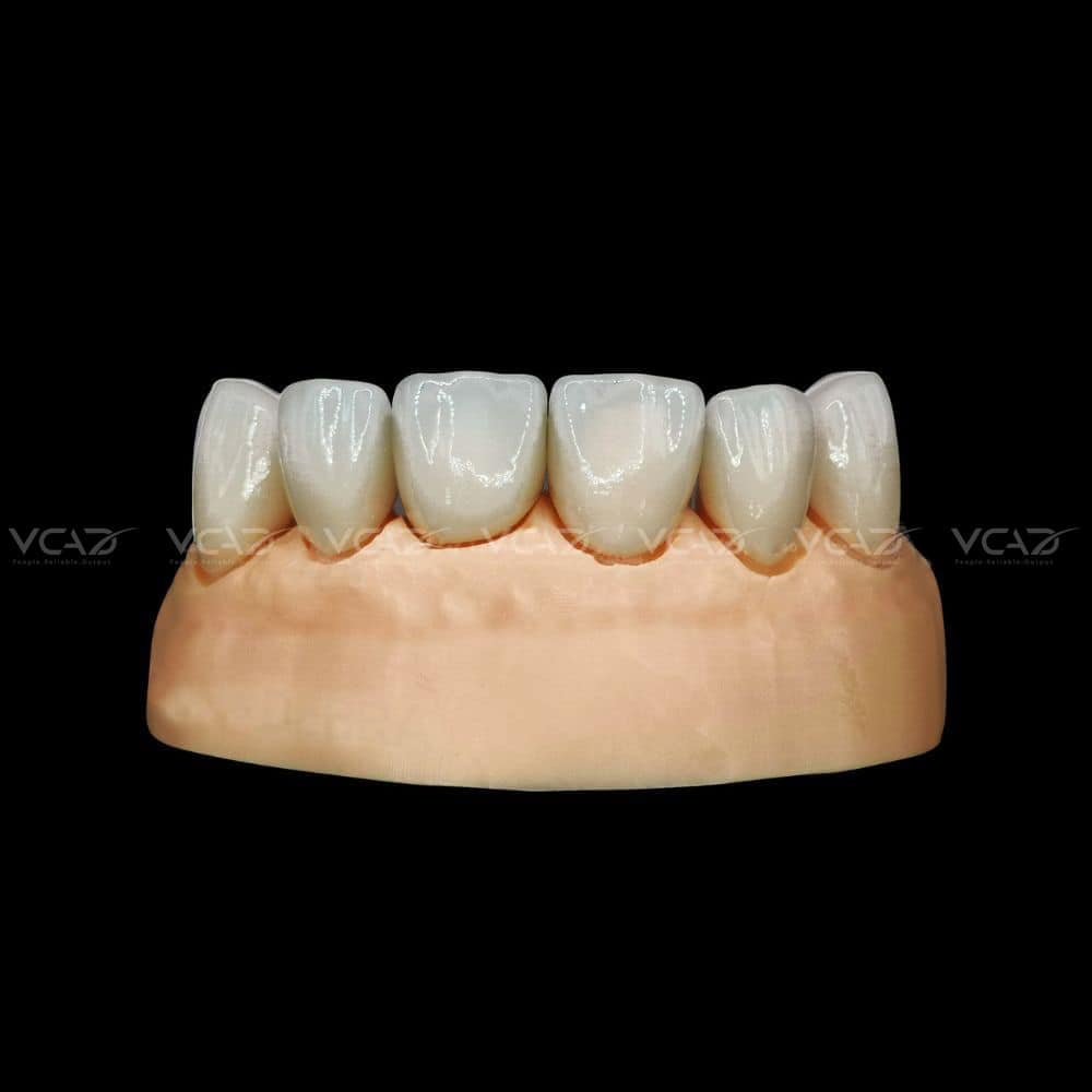 VENEERS