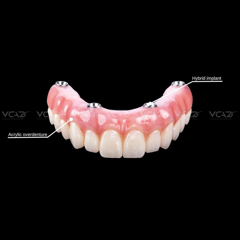 IMPLANT - RETAINED OVERDENTURES