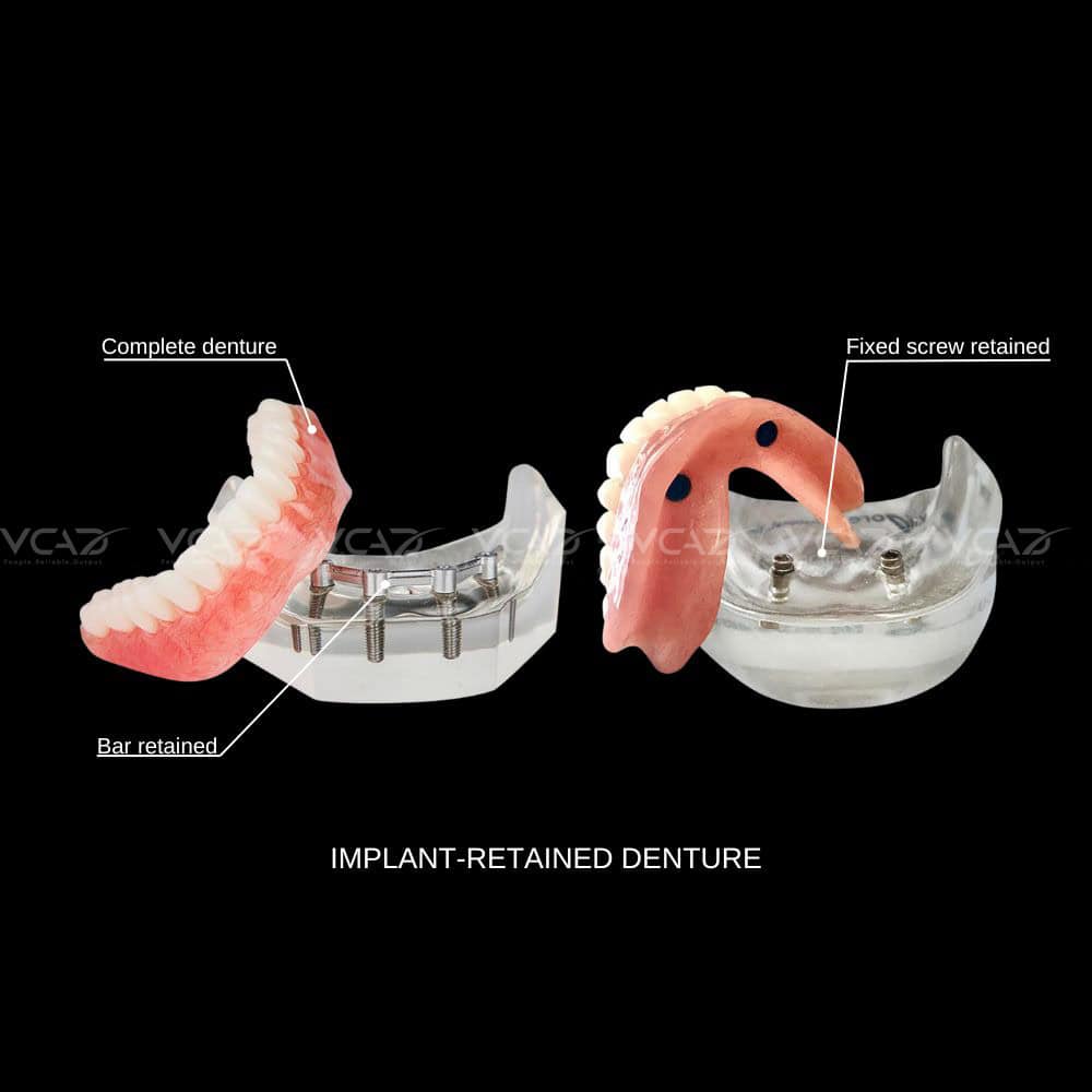 DENTURE ON IMPLANT
