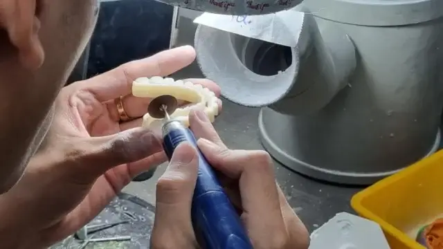 Esthetic Zone Around a Dental Implant