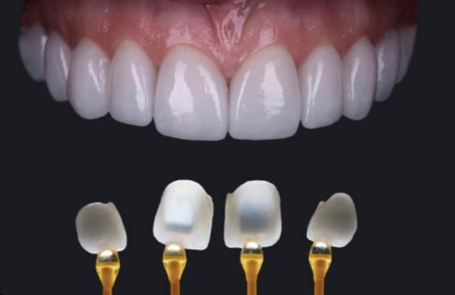 Premium crowns – close-up esthetics