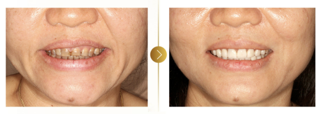 Clinical smile outcome
